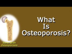 Read more about the article What Is Osteoporosis?