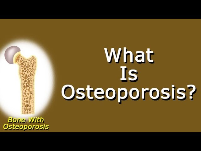 You are currently viewing What Is Osteoporosis?