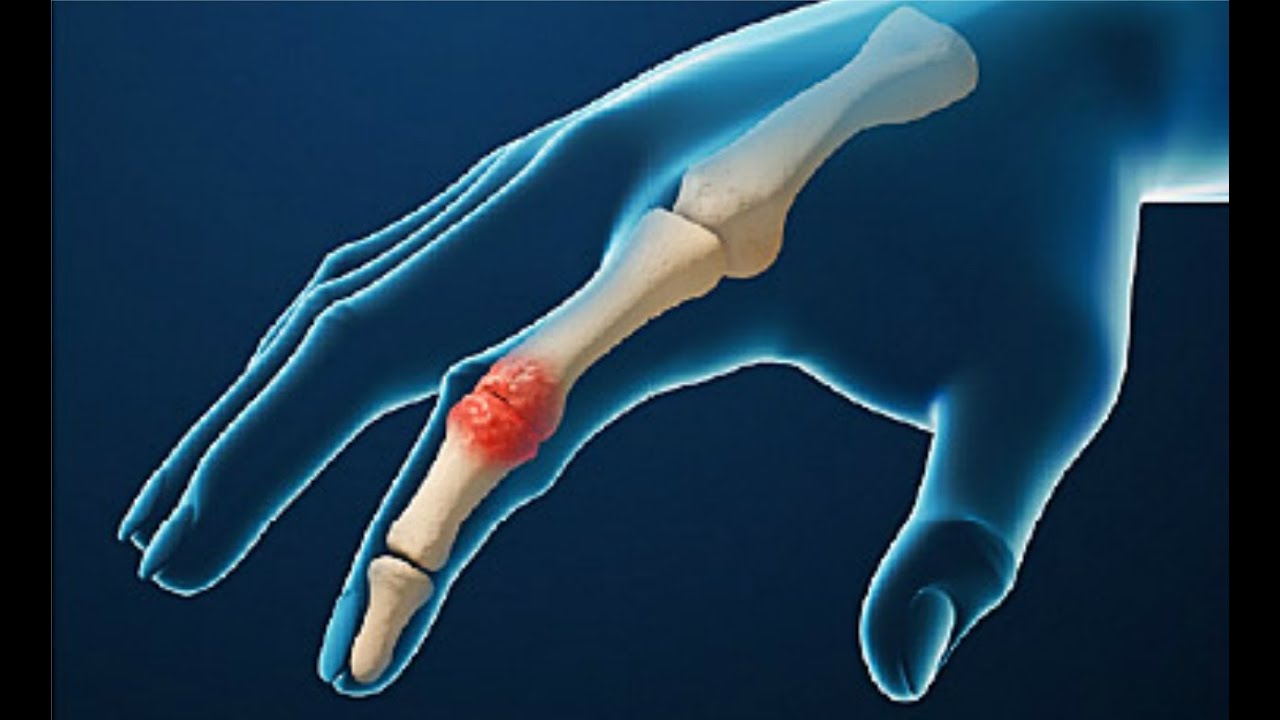 You are currently viewing What Is Rheumatoid Arthritis?