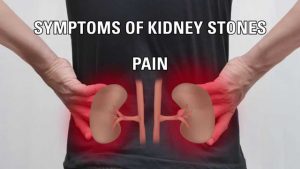 Read more about the article What are kidney stones, what causes them, and how do I prevent them?