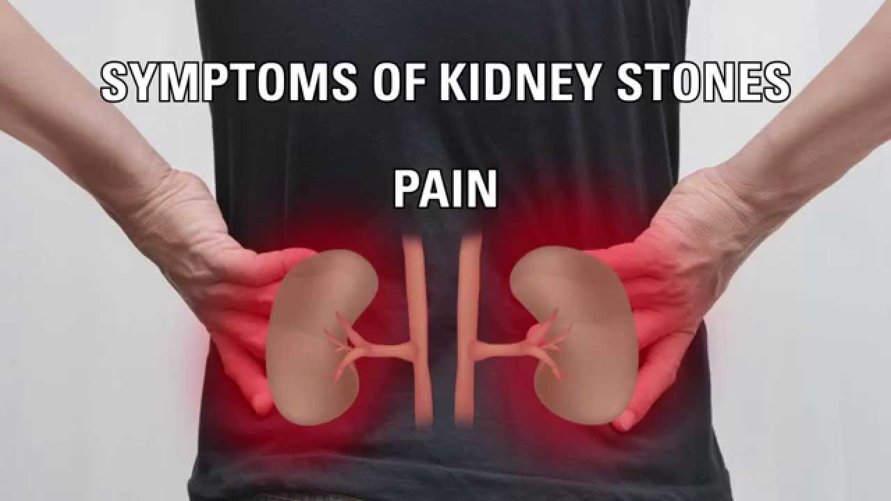 You are currently viewing What are kidney stones, what causes them, and how do I prevent them?