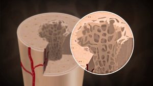 Read more about the article What causes Osteoporosis?