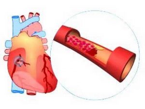 Read more about the article What causes a heart attack?