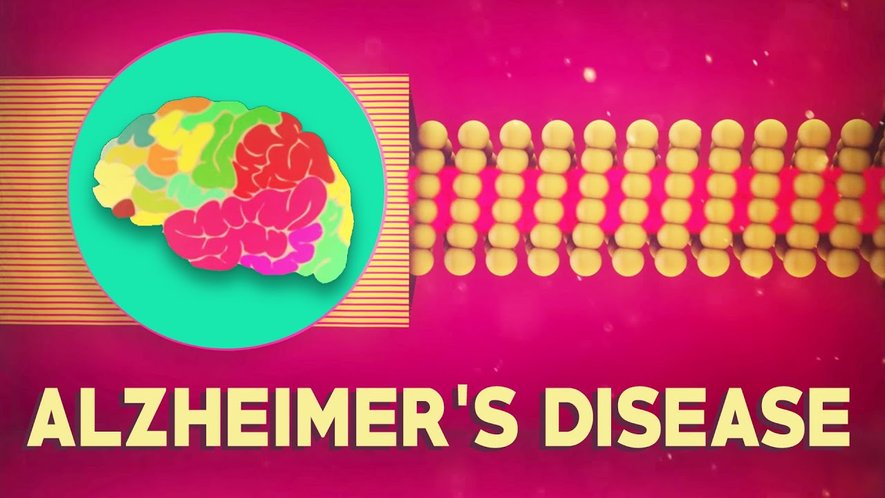 You are currently viewing What is Alzheimer’s disease? – Ivan Seah Yu Jun
