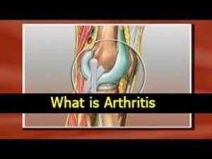 Read more about the article What is Arthritis – Causes, Symptoms, Treatments and Diet Tips in English