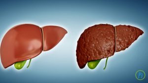 Read more about the article What is Liver cirrhosis?