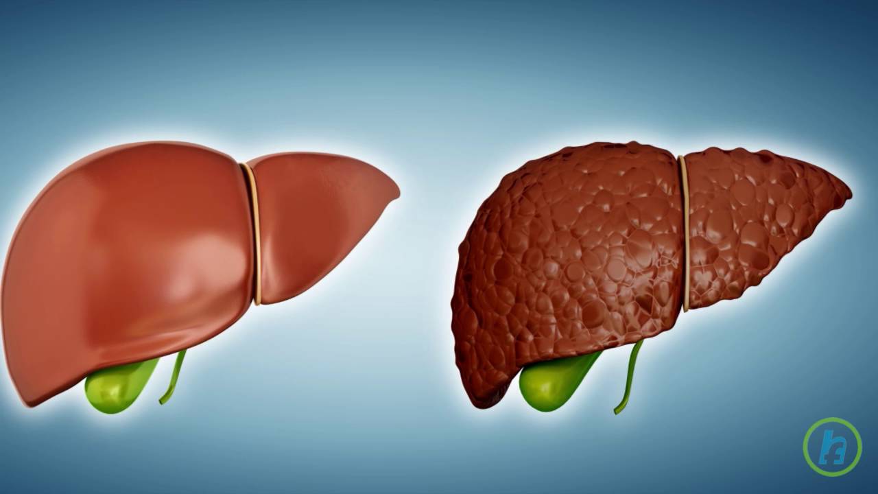You are currently viewing What is Liver cirrhosis?