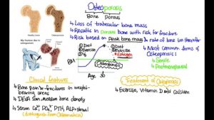 Read more about the article What is Osteoporosis?!
