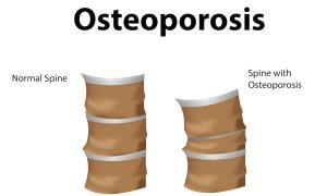 Read more about the article What is Osteoporosis?