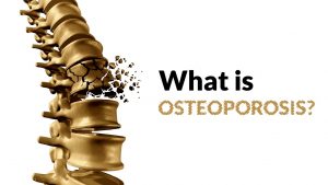 Read more about the article What is Osteoporosis?