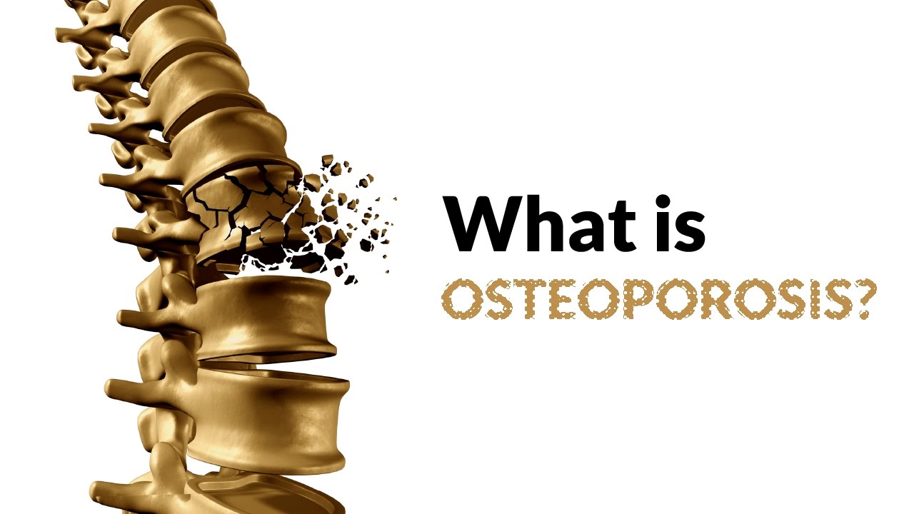 You are currently viewing What is Osteoporosis?