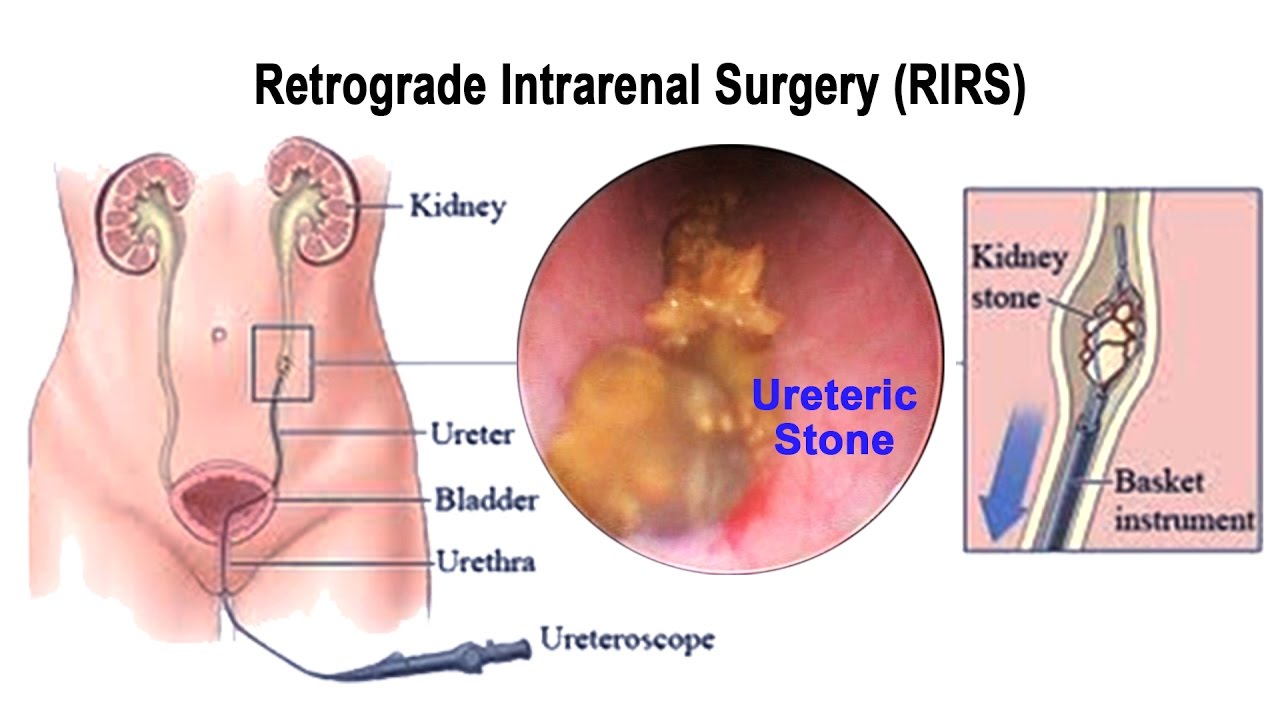 You are currently viewing What is RIRS & How Retrograde Intrarenal Surgery Removes Kidney Stones