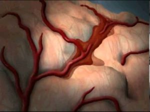 Read more about the article What is Stroke (Cerebrovascular Accident)?
