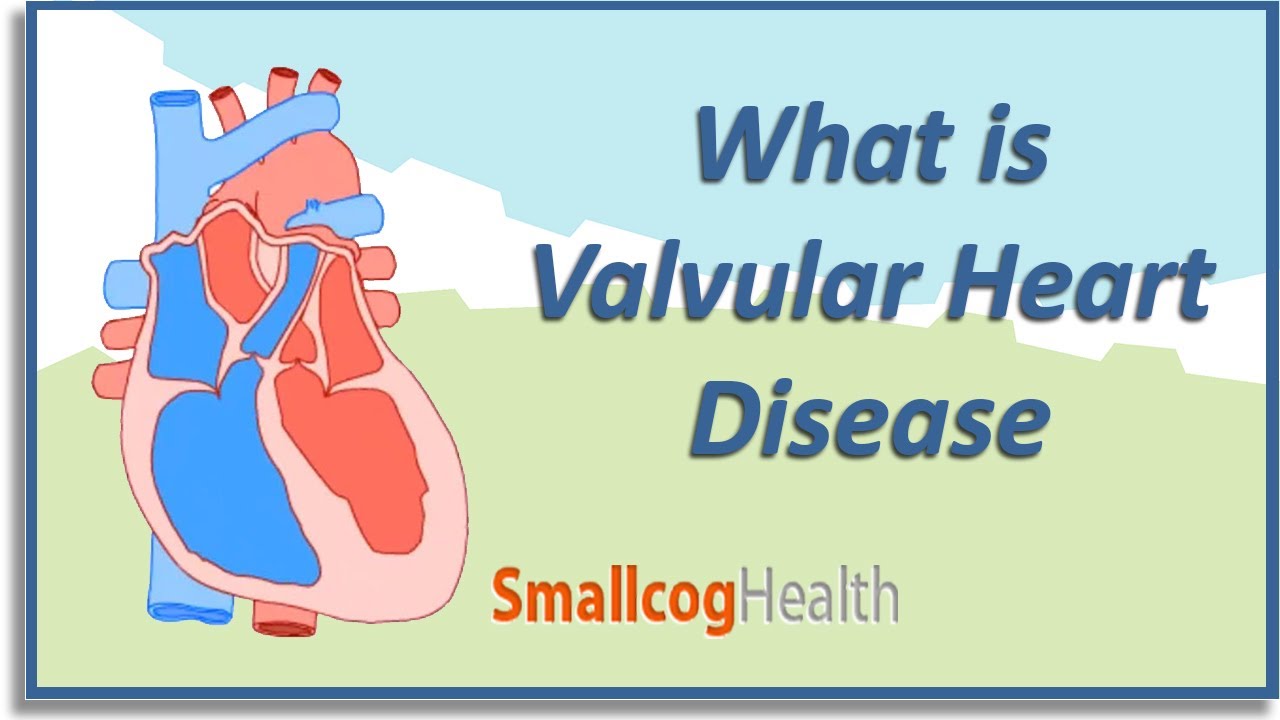You are currently viewing What is Valvular Heart Disease