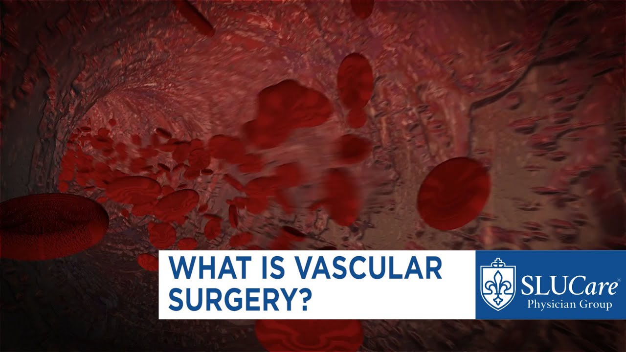 You are currently viewing Vascular Surgery Video – 5