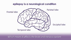 Epilepsy Video – 1