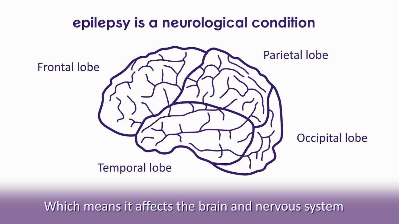 You are currently viewing Epilepsy Video – 1