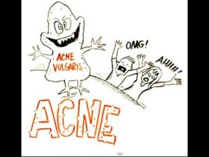 Read more about the article What is the Best Way to Treat Acne?