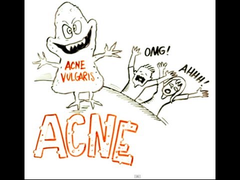 You are currently viewing What is the Best Way to Treat Acne?