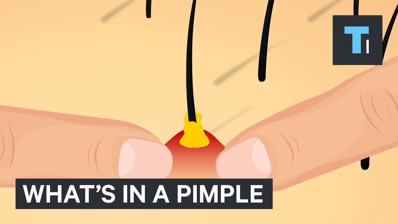 You are currently viewing What’s Inside A Pimple?