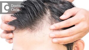 Read more about the article Who is best to consult for Androgenic Alopecia? – Dr. Aruna Prasad