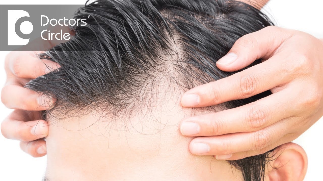 You are currently viewing Who is best to consult for Androgenic Alopecia? – Dr. Aruna Prasad