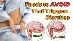 Read more about the article Worst Foods to Avoid That Spikes Diarrhea Again