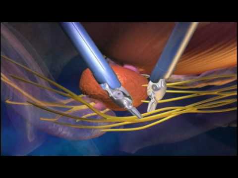 You are currently viewing Robotics Surgeries Video – 3