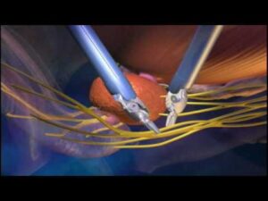 Urology Surgery Video – 4