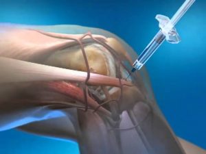 Read more about the article euflexxa knee injection animation