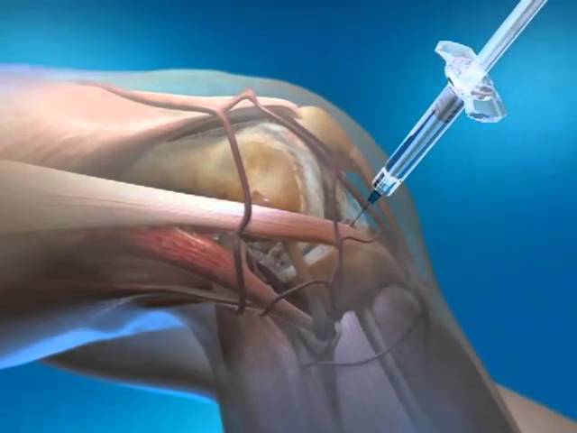 You are currently viewing euflexxa knee injection animation