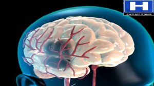 what is brain hemorrhage – how brain hemorrhage occurs brain hemorrhage – Treatment options