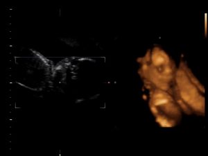 Read more about the article 2D & 3D Ultrasound Side By Side Preview (Sonography)