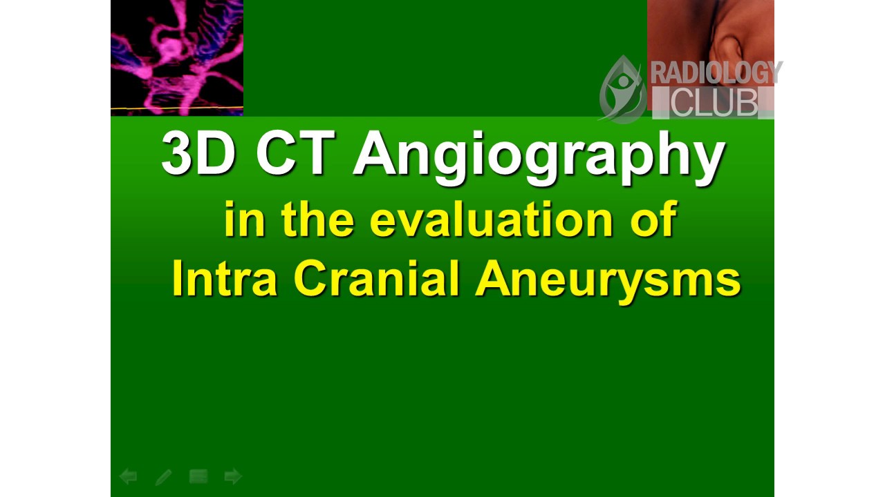 You are currently viewing 3D CT Angiography  in the evaluation of Intra Cranial Aneurysms – Seminar PPT Presentation