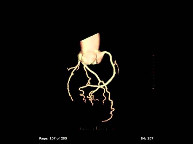 You are currently viewing 3D Coronary arteries on a Cardiac CT scan