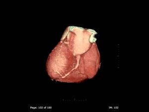 Read more about the article 3D Heart on a Cardiac CT scan