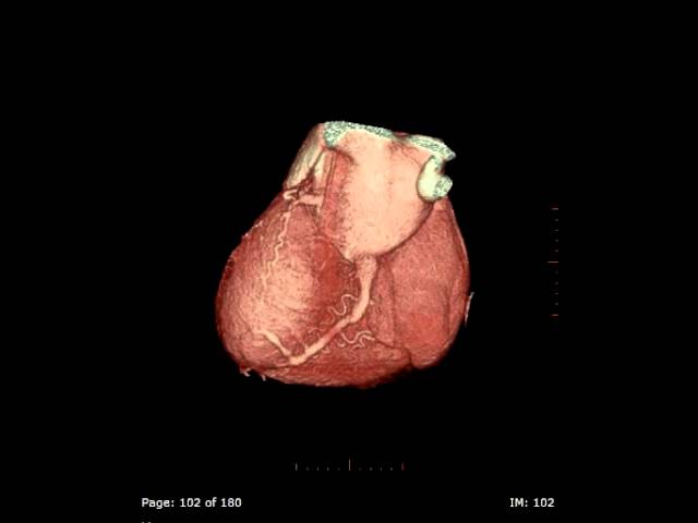 You are currently viewing 3D Heart on a Cardiac CT scan