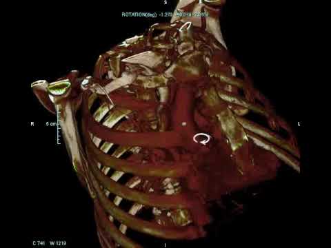 You are currently viewing 3D visualization of Aorta from CT angio images