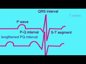 Read more about the article AP2 EXAM 1: ABNORMAL ECGs.avi