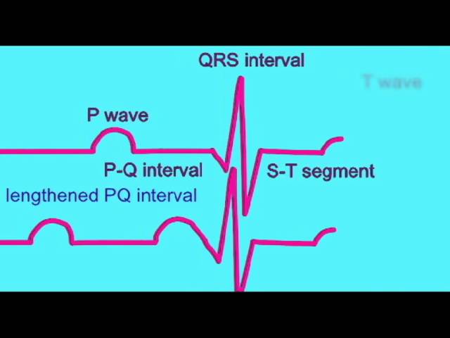 You are currently viewing AP2 EXAM 1: ABNORMAL ECGs.avi