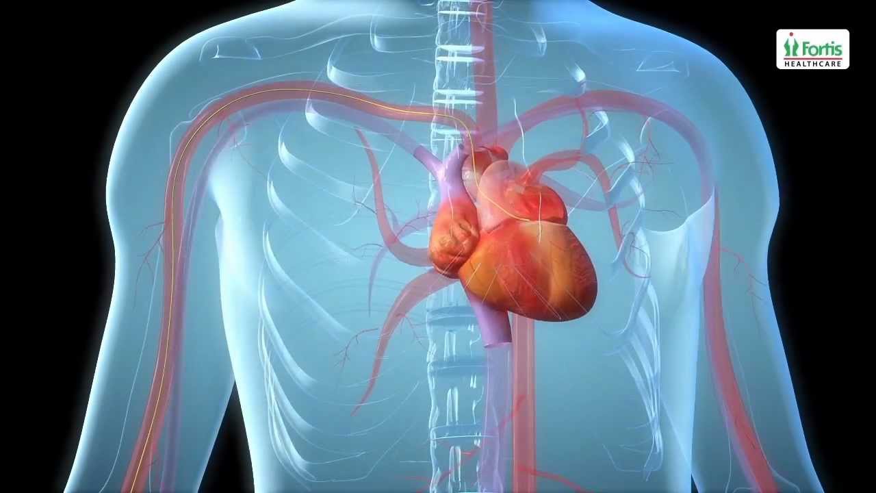 You are currently viewing Angioplasty Procedure Animation Video.