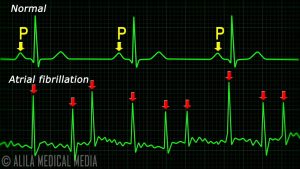 Atrial Fibrillation Anatomy, ECG and Stroke, Animation.