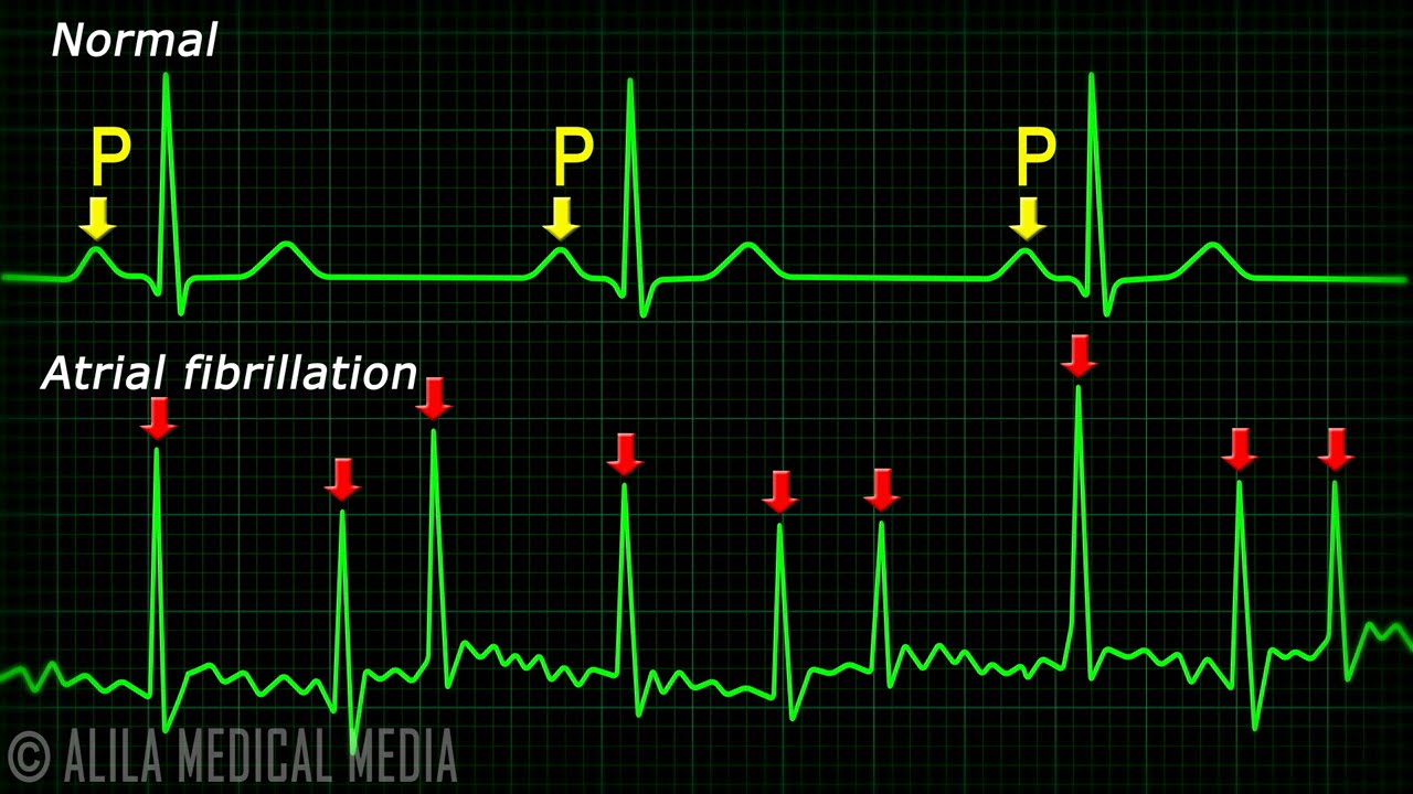 You are currently viewing Atrial Fibrillation Anatomy, ECG and Stroke, Animation.