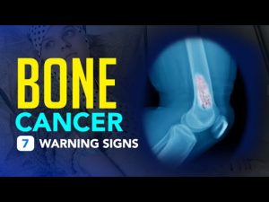Bone Cancer – 7 Warning Signs