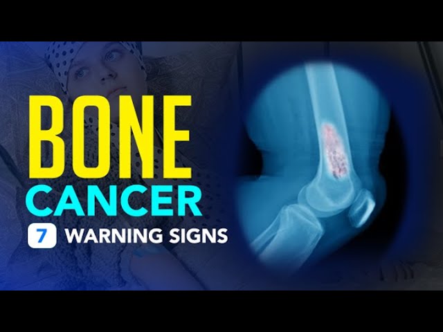 You are currently viewing Bone Cancer – 7 Warning Signs