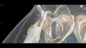Read more about the article CT lower limb angiography (Siemens 16 + OsiriX)