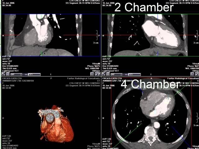 You are currently viewing Coronary CT Angiography: RCA Stenosis