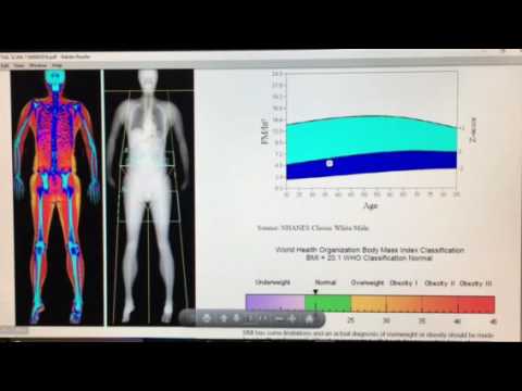 You are currently viewing Dexa Scan Explanation