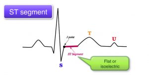 Read more about the article ECG Basics 9/10 – ST interval, T wave and U wave