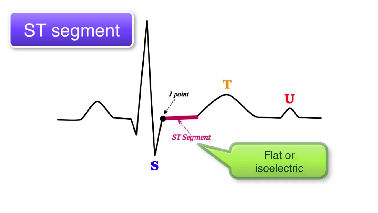 You are currently viewing ECG Basics 9/10 – ST interval, T wave and U wave